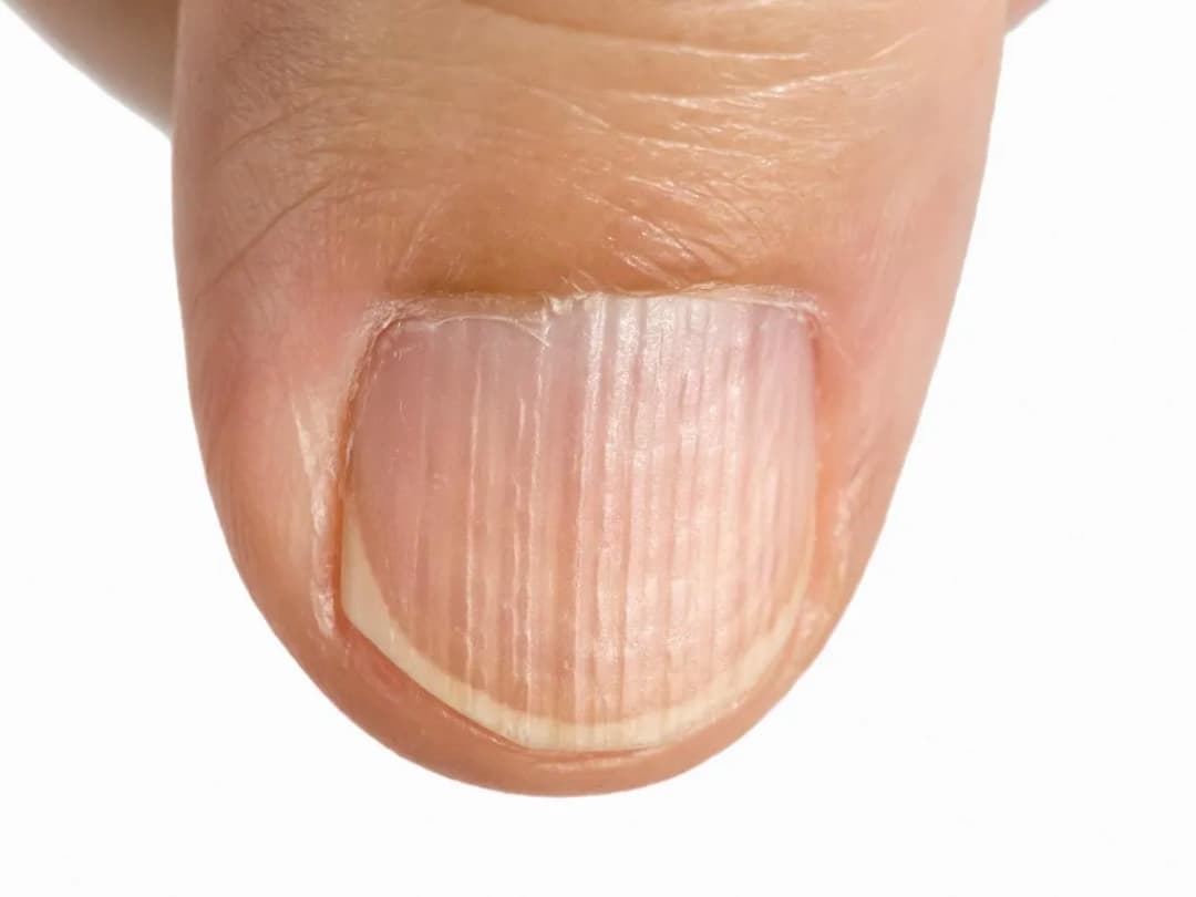 Bruzdy na paznokciach – co oznaczają i jak sobie z nimi poradzić?