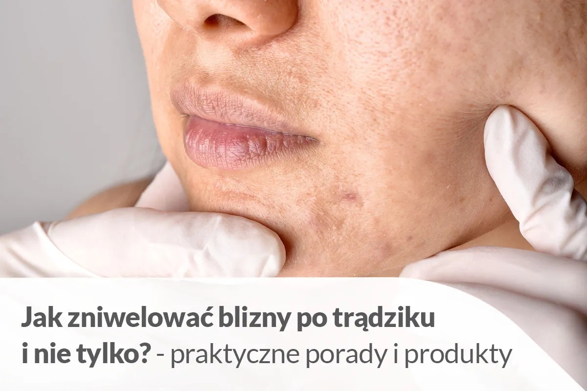 Skuteczne metody na gojenie ran po pryszczach i bliznach skórnych